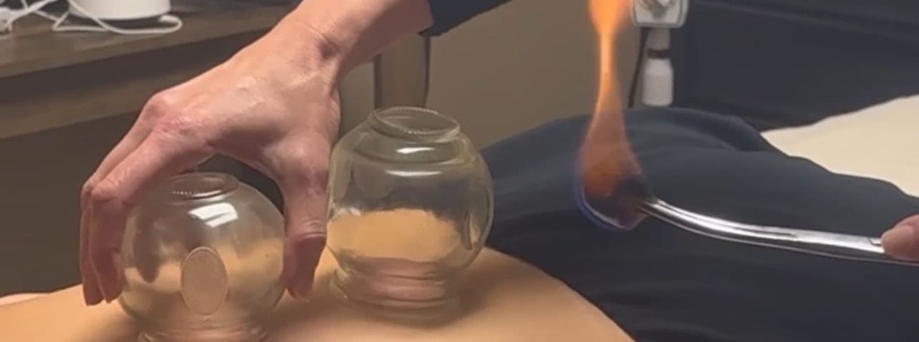 Cupping therapy treatment